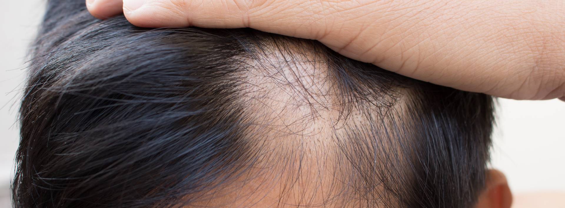 Hair loss treatment
